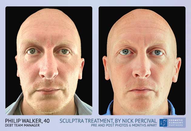 Male Sculptra treatment before and after photos
