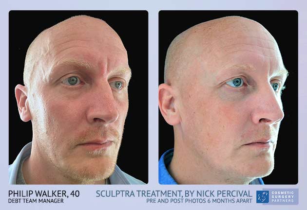 Male Sculptra treatment before and after photos