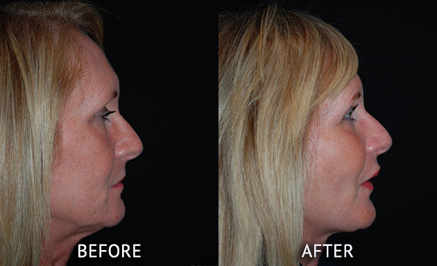 face lift at cosmetic surgery partners before and after right side view